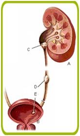 Urologie niersteen